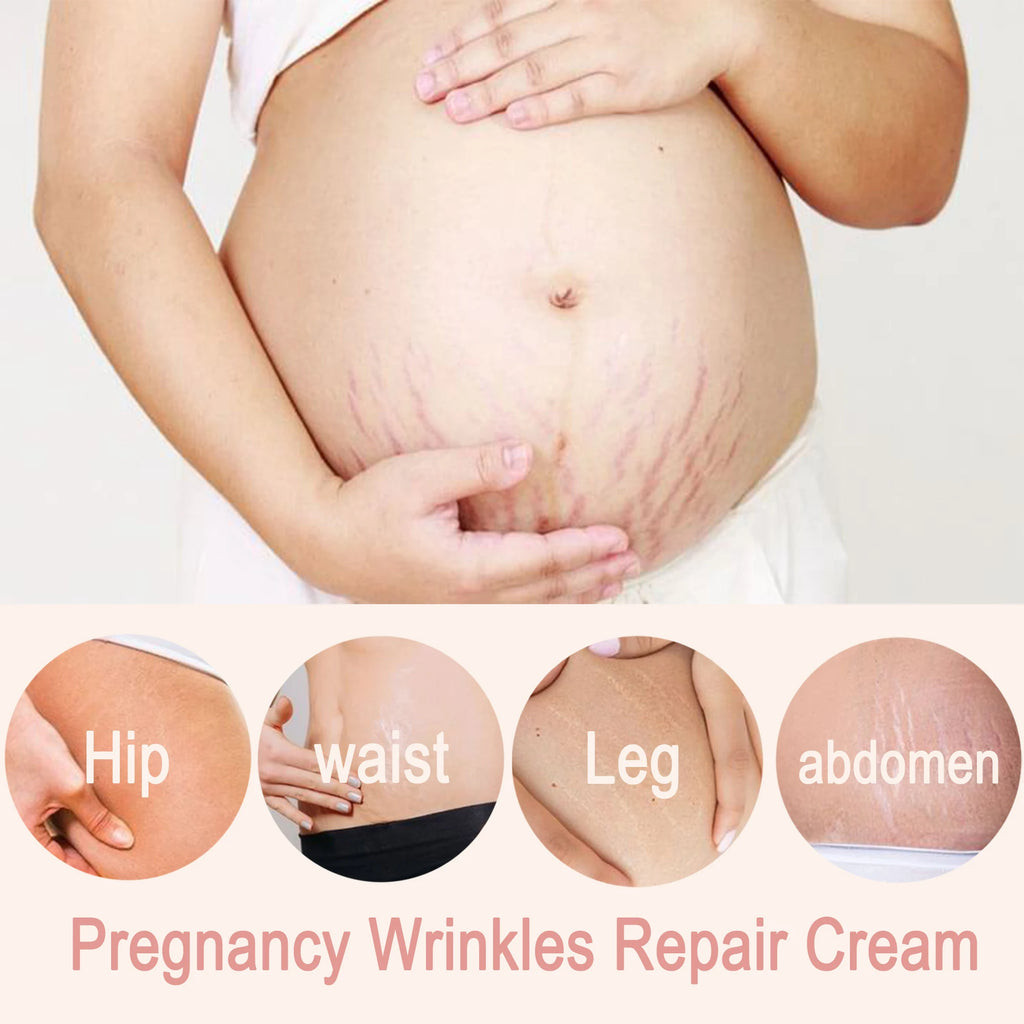 Remove stretch marks cream, promote cell regeneration, increase fiber elasticity